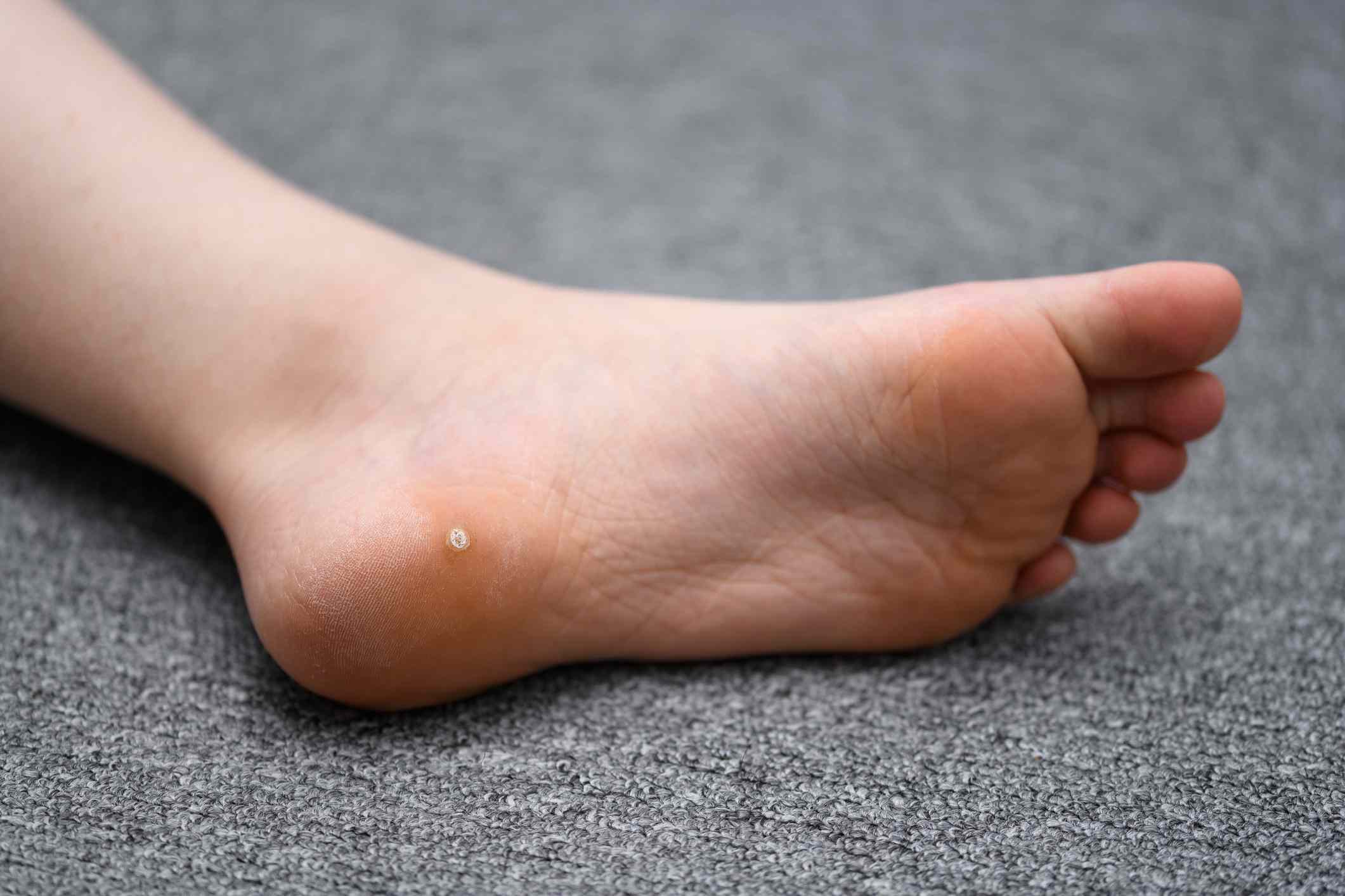 Plantar warts treatment to remove HPV-related foot warts and relieve pain when walking Plantar warts treatment to remove HPV-related foot warts and relieve pain when walking