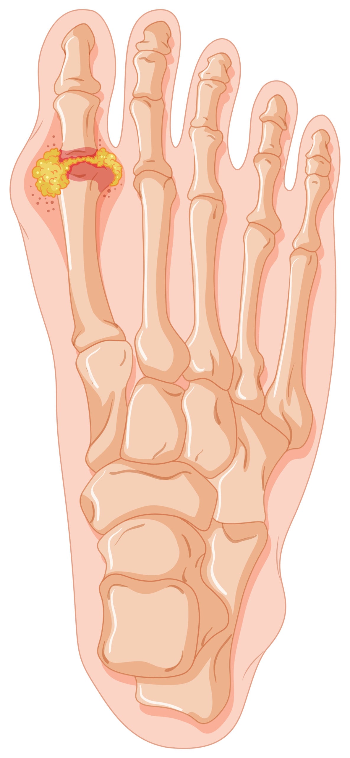 Gout treatment for sudden arthritis pain, swollen joints, and foot inflammation relief Gout treatment for sudden arthritis pain, swollen joints, and foot inflammation relief