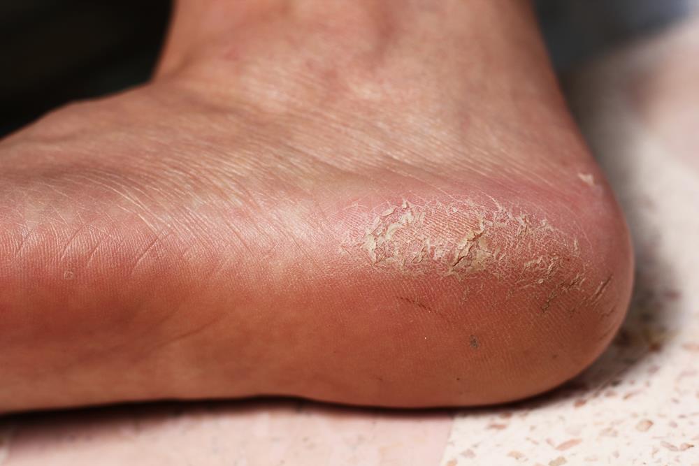 Callus treatment foot old greenwich Callus treatment foot old greenwich